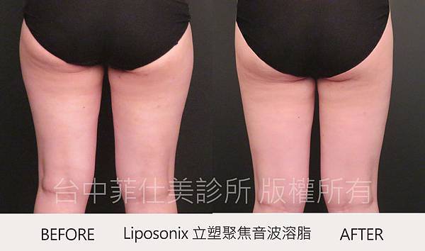 台中立塑溶脂推薦菲仕美朱純慧醫師 台中立塑溶脂推薦菲仕美朱純慧醫師