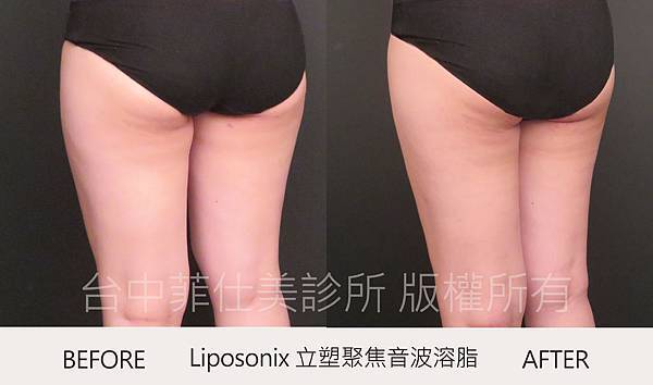 台中立塑溶脂推薦菲仕美朱純慧醫師 台中立塑溶脂推薦菲仕美朱純慧醫師