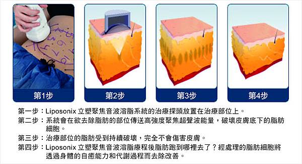 liposonix立塑聚焦音波溶脂價錢 liposonix立塑聚焦音波溶脂價錢