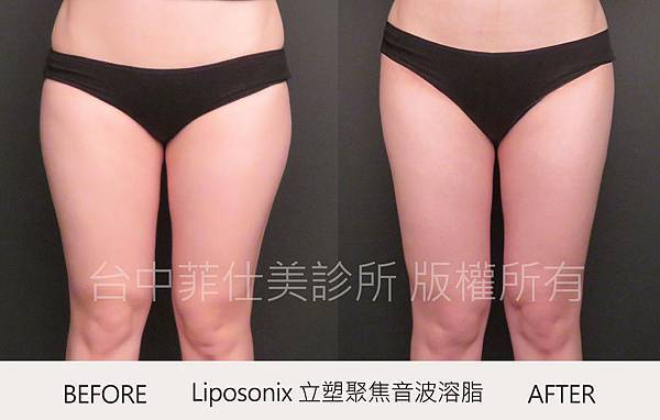 台中立塑溶脂推薦菲仕美朱純慧醫師 台中立塑溶脂推薦菲仕美朱純慧醫師