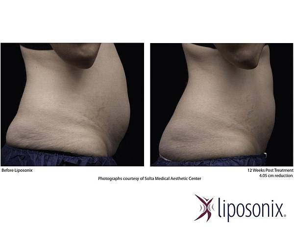 台中立塑溶脂推薦菲仕美朱純慧醫師 台中立塑溶脂推薦菲仕美朱純慧醫師