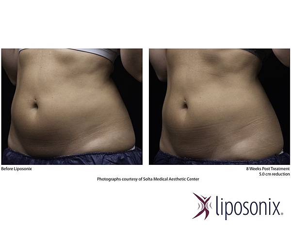 台中立塑溶脂推薦菲仕美整形外科女醫師朱純慧醫師 台中立塑溶脂推薦菲仕美整形外科女醫師朱純慧醫師