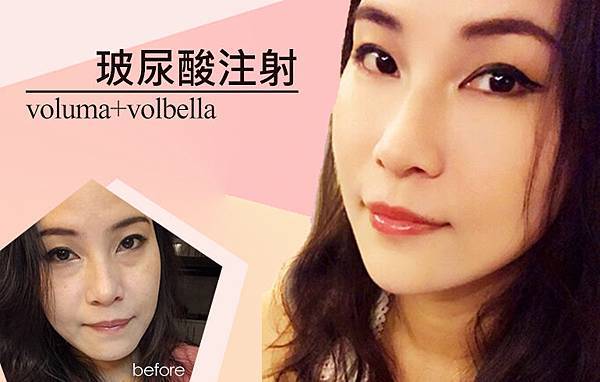 台中玻尿酸注射|台中醫美玻尿酸微整|菲仕美診所許永昌醫師 台中玻尿酸注射|台中醫美玻尿酸微整|菲仕美診所許永昌醫師