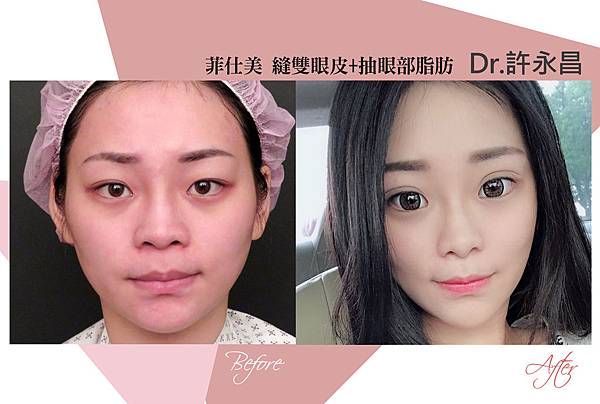 台中雙眼皮手術|台中縫雙眼皮權威|台中菲仕美 台中雙眼皮手術|台中縫雙眼皮權威|台中菲仕美