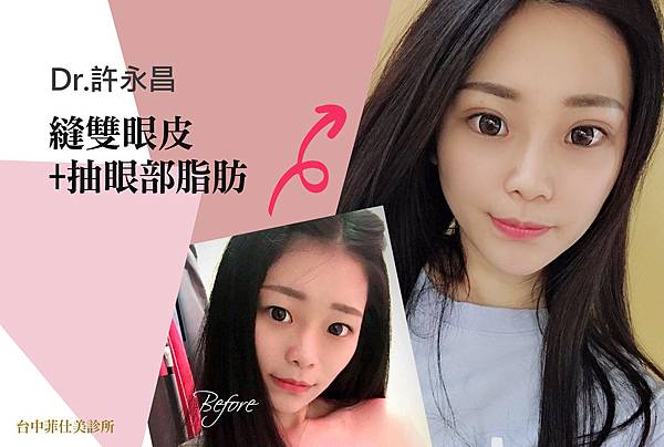 台中雙眼皮手術|台中縫雙眼皮權威|台中菲仕美 台中雙眼皮手術|台中縫雙眼皮權威|台中菲仕美