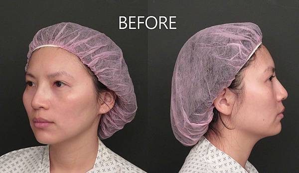 台中自體脂肪豐頰抹去歲月的痕跡 找回豐盈自信的鵝蛋臉台中菲仕美 自體脂肪補臉 抽脂補臉 自體脂肪填補蘋果肌 自體脂肪填補太陽穴 自體脂肪填補夫妻宮 自體脂肪填補法令紋 整形外科許永昌醫師 台中自體脂肪豐頰自體脂肪填補蘋果肌 整形外科許永昌醫師