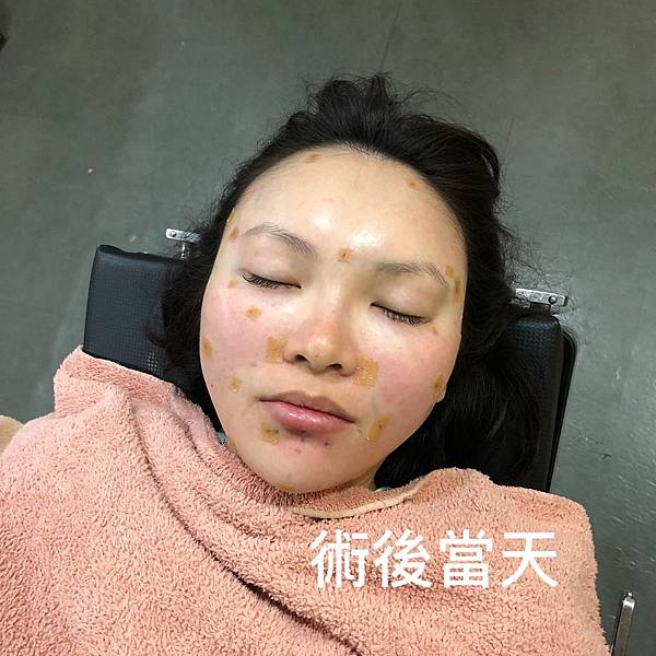 台中自體脂肪豐頰抹去歲月的痕跡 找回豐盈自信的鵝蛋臉台中菲仕美 自體脂肪補臉 抽脂補臉 自體脂肪填補蘋果肌 自體脂肪填補太陽穴 自體脂肪填補夫妻宮 自體脂肪填補法令紋 整形外科許永昌醫師 台中自體脂肪豐頰抹去歲月的痕跡 找回豐盈自信的鵝蛋臉台中菲仕美 自體脂肪補臉 抽脂補臉 自體脂肪填補蘋果肌 自體脂肪填補太陽穴 自體脂肪填補夫妻宮 自體脂肪填補法令紋 整形外科許永昌醫師