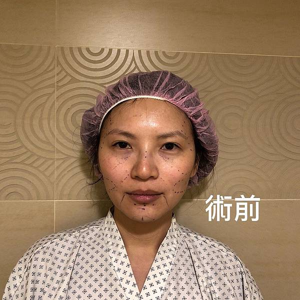 台中自體脂肪豐頰自體脂肪填補蘋果肌 整形外科許永昌醫師