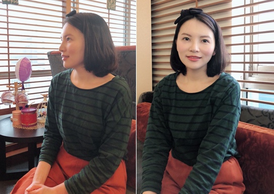 台中自體脂肪豐頰 菲仕美整形外科許永昌醫師 台中自體脂肪豐頰 菲仕美整形外科許永昌醫師