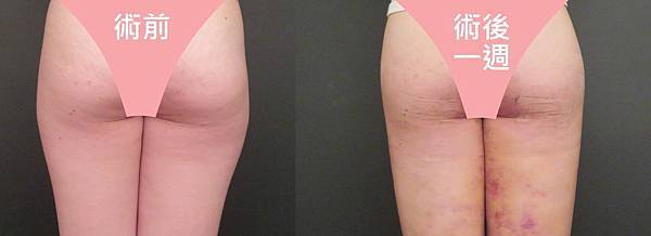 台中威塑抽脂台中抽脂推薦菲仕美診所