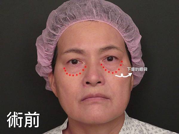 台中眼袋外科│台中眼袋推薦│眼袋手術填補淚溝│菲仕美整形外科診所 台中眼袋外科│台中眼袋推薦│眼袋手術填補淚溝│菲仕美整形外科診所