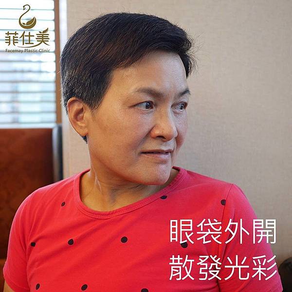 台中眼袋外科│台中眼袋推薦│眼袋手術填補淚溝│菲仕美整形外科診所 台中眼袋外科│台中眼袋推薦│眼袋手術填補淚溝│菲仕美整形外科診所