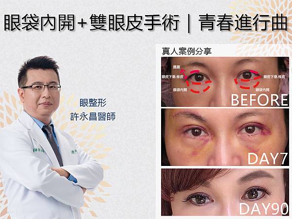 眼袋-太太的姊姊.jpg 眼袋-太太的姊姊.jpg