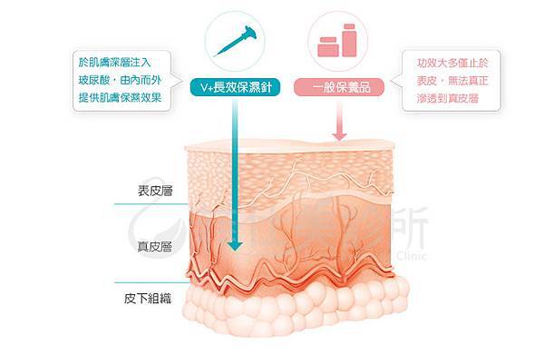 台中玻尿酸,台中玻尿酸ptt,台中玻尿酸價格,台中玻尿酸保濕,台中玻尿酸推薦,台中玻尿酸全臉保濕,台中打玻尿酸,玻尿酸,台中醫美推薦,台中醫美診所,台中打玻尿酸,喬雅登VOLITE,喬雅登劑型,喬雅登VOLITE價格,喬雅登玻尿酸劑型,juvederm喬雅登,喬雅登VOLITE,長效保濕針,楊學穎,朱純慧,許永昌