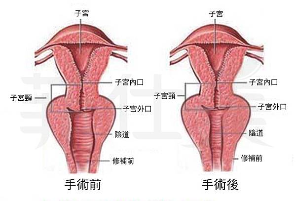 陰道緊縮手術.jpg