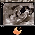 baby#2 21w (3) 醫生：It's definitely a boy! 