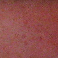 pimple1.jpg