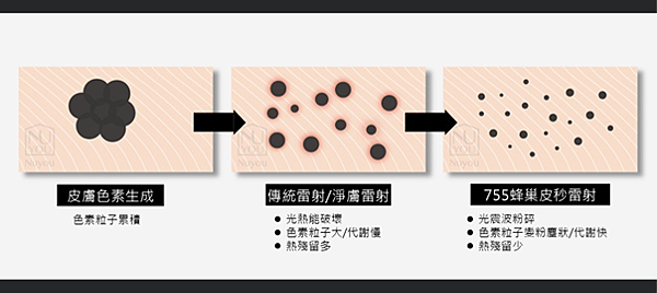 世界上最棘手嘅斑 — 荷爾蒙斑你有無？