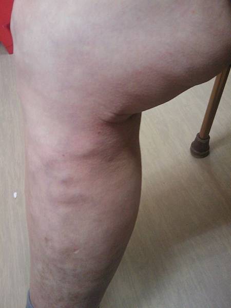 Thrombophlebitis