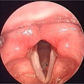 聲帶息肉 治療前