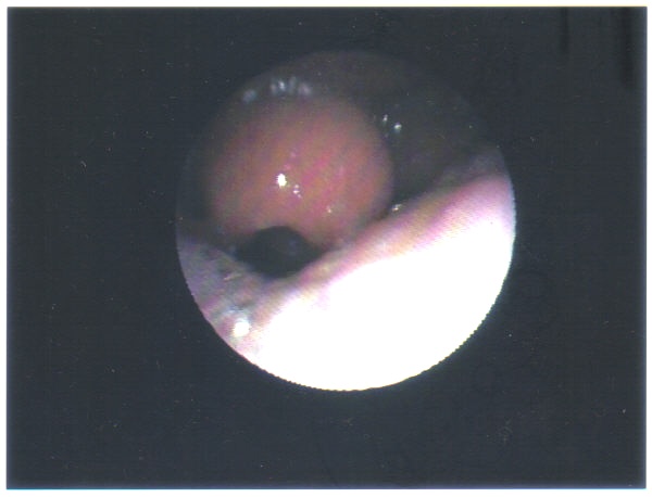 Acute Epiglottitis.jpg