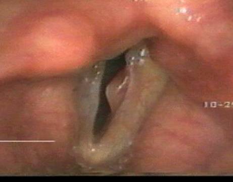 Vocal polyp.jpg