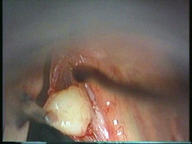 Vocal cyst.JPG