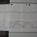 小孩心跳與宮縮指數