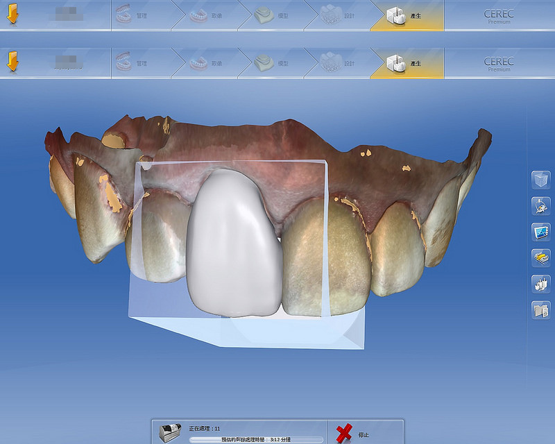 3.設計患者的全瓷冠-2