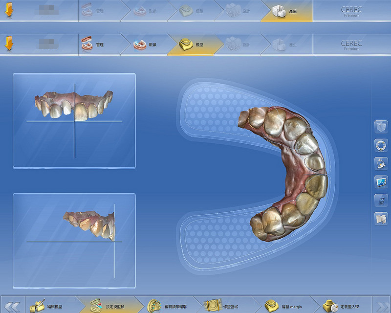 2.牙技師設計患者的全瓷冠-1
