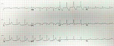 預激症候群 沃夫 巴金森 懷特症候群 Wpw 天天醫師談心事 痞客邦