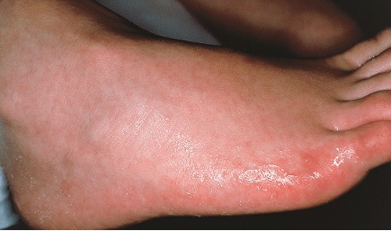 plantar hyperhidrosis.jpg