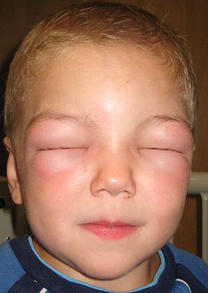 300px-Angioedema2010.jpg