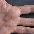 dyshidrotic_eczema_hand_2.JPG