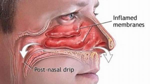 Post-Nasal-Drip.jpg