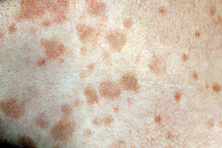 tinea-versicolor-overview.jpg