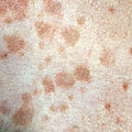 tinea-versicolor-overview.jpg