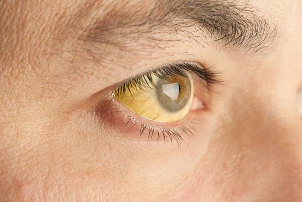 jaundice-is-a-sign-of-yellow-fever.jpg