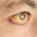jaundice-is-a-sign-of-yellow-fever.jpg