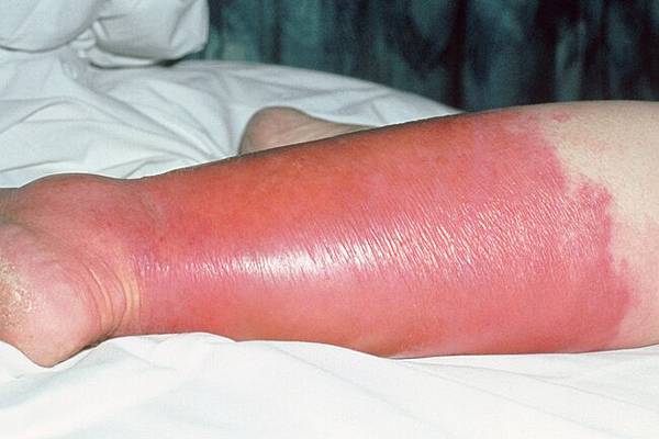 1800ss_sciencesource_rm_red_swollen_leg_cellulitis.jpg