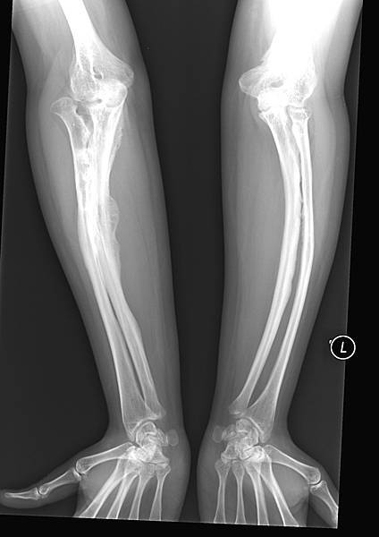 X-ray-adult-osteogenesis-imperfecta.jpg