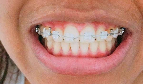 蔆兒的郝婐牙套日記 拆牙套都一年啦 牙套人生不到一年半 蔆兒熱追趕跑跳碰 痞客邦