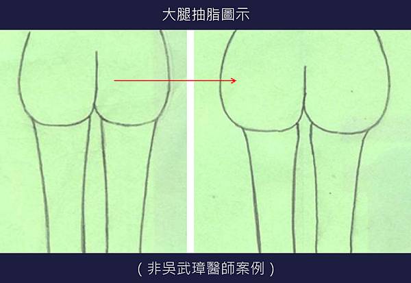 大腿抽脂吃到飽2-03