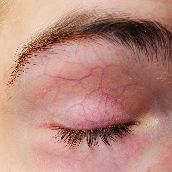 静脉曲张爬上脸!血管型黑眼圈越冷越严重!