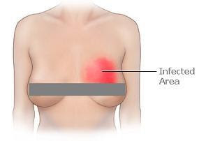 Mastitis乳腺炎症狀