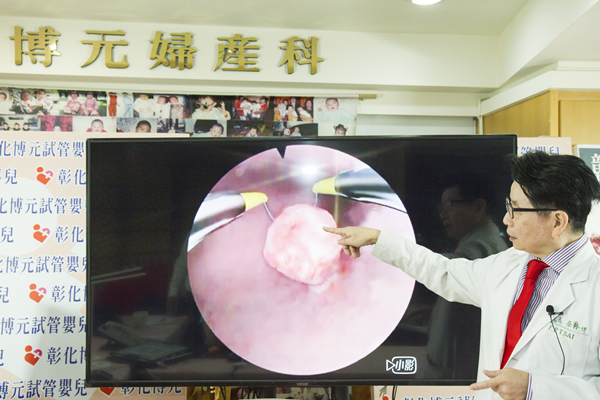 子宮瘜肉大如野柳女王頭 子宮鏡手術後試管懷孕成功2.png 子宮瘜肉大如野柳女王頭 子宮鏡手術後試管懷孕成功2.png