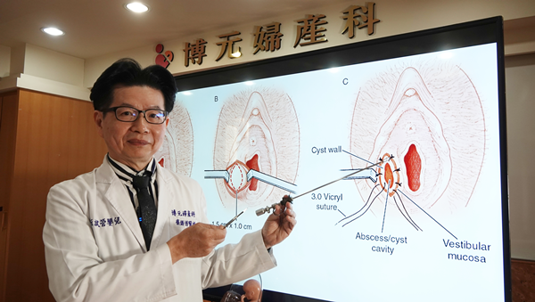 外陰部竟腫得像饅頭 博元婦產科醫師2分鐘搞定巴氏腺囊腫3.png