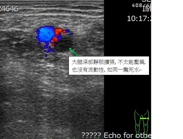 彰化老翁下肢腫脹差點要人命 小心是深部靜脈血栓3.png