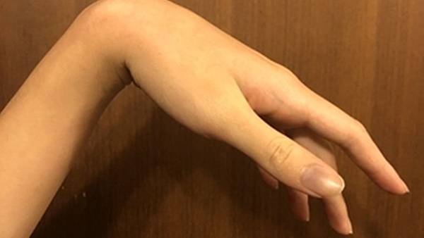 手腕不舉非中風 員榮醫療中西合併治「蜜月麻痺」2.jpg 手腕不舉非中風 員榮醫療中西合併治「蜜月麻痺」2.jpg