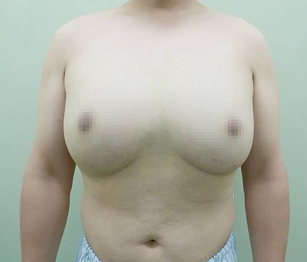 彰基3D內視鏡乳房手術重建 意外掀D奶男霸凌史2.jpg 彰基3D內視鏡乳房手術重建 意外掀D奶男霸凌史2.jpg